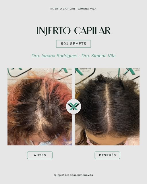 ✨ Densidad y armonía en el triángulo frontal.

Recuperar el grosor en la zona anterior transforma po