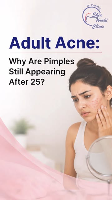 Adult acne can appear due to hormonal changes, stress, poor sleep, unsuitable skincare products, die