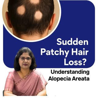 Have you noticed sudden patchy hair loss on your scalp, eyebrows, beard, eyelashes, or other body ar