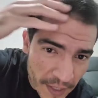 Quatro meses depois do transplante capilar, o músico e futuro médico Gabriel @eugabrielsttuck já est
