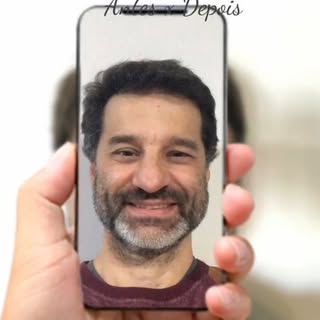 Confira esse antes e depois incrível do paciente Cezar,  @pestana.cezar, com procedimento realizado 
