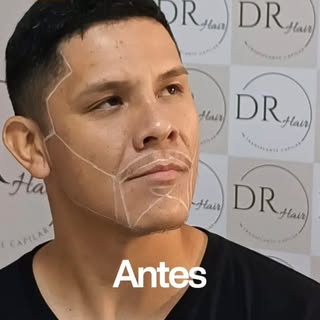 Quem vê o antes e depois do Felipe Valdez entende o poder de um transplante de barba bem planejado. 