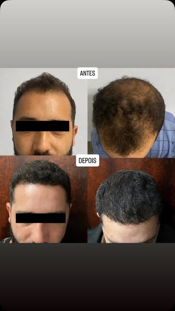 Mais um paciente cabeludo e com a autoestima renovada.

#transplantecapilarfue #transplantecapilar