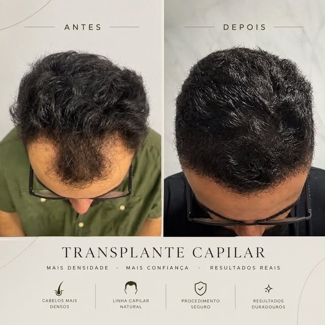 A magia do nosso transplante capilar FUE