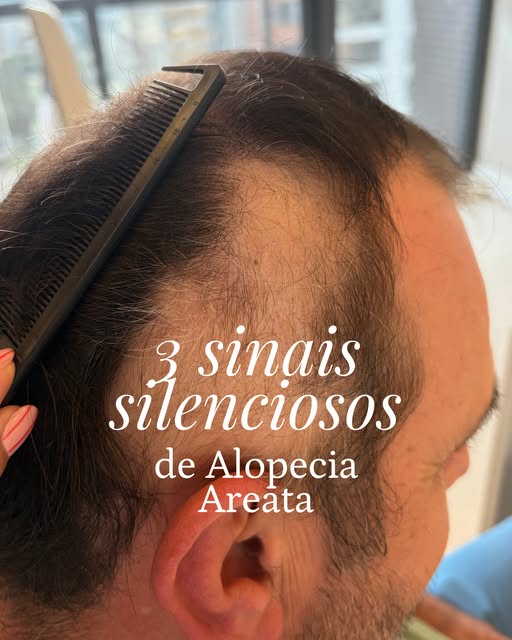 A alopecia areata pode começar de forma discreta e, justamente por isso, alguns sinais acabam passan