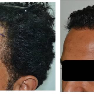 Some of my Hairtansplant surgeries