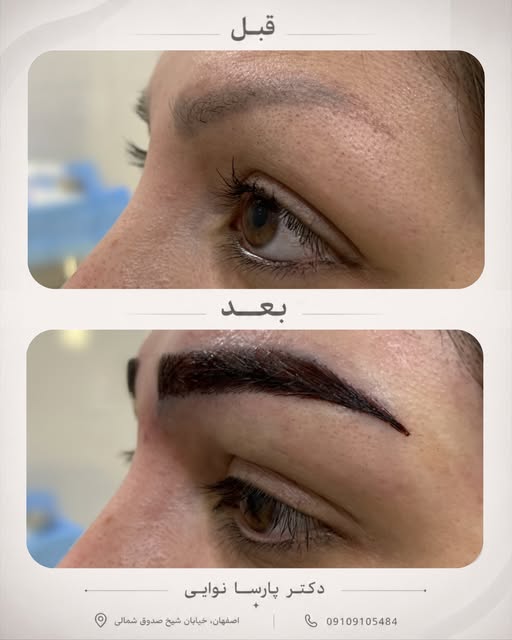 کاشت ابرو برای همه یک مدل و یک نتیجه نداره. 🤍
فرم صورت، تراکم موردنظر و طراحی ابرو، همگی روی نتیجه 