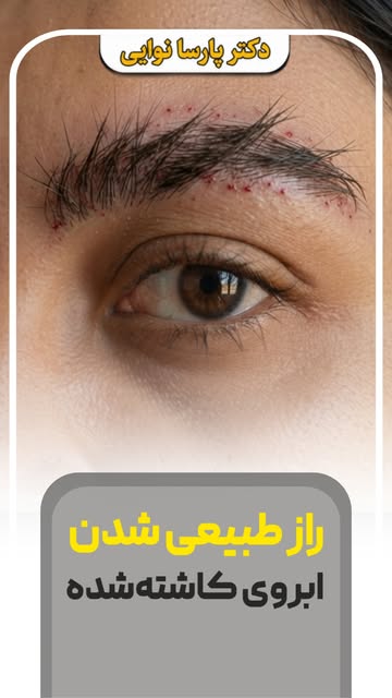 ابروی طبیعی فقط به تراکم مو نیست؛ زاویه کاشت هم تعیین‌کننده‌ست.

در سینایار، قبل از کاشت، زاویه رشد 