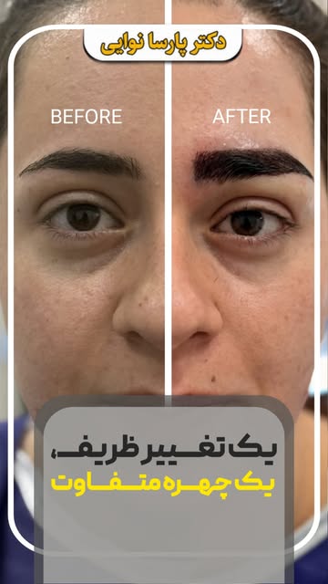 هر چهره، فرم ابروی مخصوص خودش رو می‌خواد. ✨

قبل از کاشت، فرم و تناسبات چهره به‌دقت آنالیز میشه و اب
