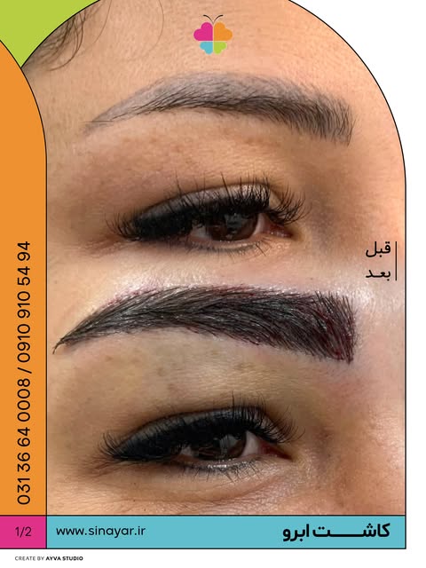 ⁨قبل و‌ بعد از کاشت ابرو…💉🧪
در کلینیک تخصصی سینایار

جهت اطلاع از قیمت کاشت ابرو کلمه ی (ابرو) را 