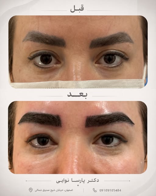💢مراجعه عزیزمون از تتوی قدیمی ابروهاشون خسته شده بودن و دیگه فرم و ظاهر ابروهاشون رو دوست نداشتن.

