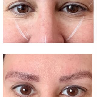 Did you know Eyebrow transplant is a permanent solution for individuals experiencing thinning, asymm