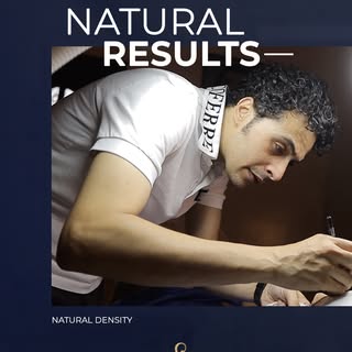 PRECISION CREATES NATURAL RESULTS ✨

In hair transplantation, natural-looking results are not only a