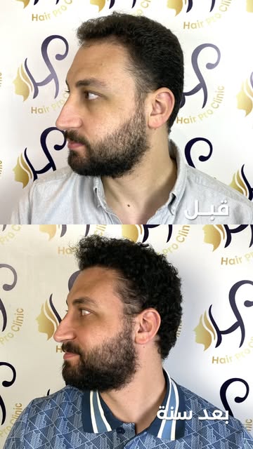 بعد سنة من زراعة الشعر بـ 1700 جرافت ✨

من تراجع في مقدمة الشعر بسبب الصلع من الدرجة الثانية (أ)، لن