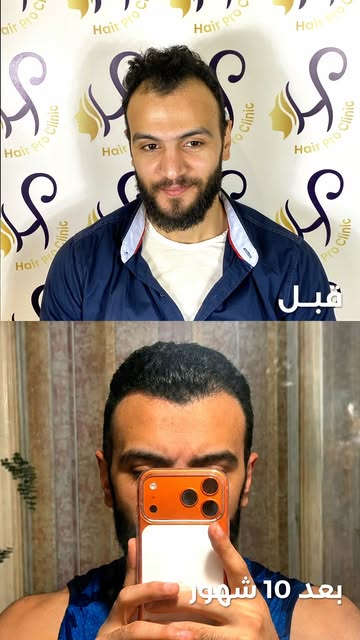 بعد 10 شهور من زراعة الشعر بـ 2500 جرافت ✨

من صلع في الدرجة الثالثة لنتيجة طبيعية أوضحت فرق واضح في