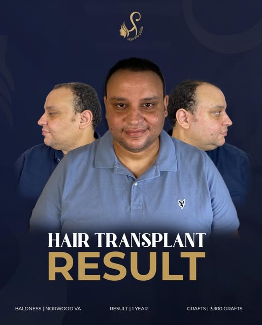 حالة صلع وراثي من الدرجة الخامسة المتقدمة، تم زراعة 3300 جرافت لاستعادة التغطية في مقدمة ومنتصف الرأ