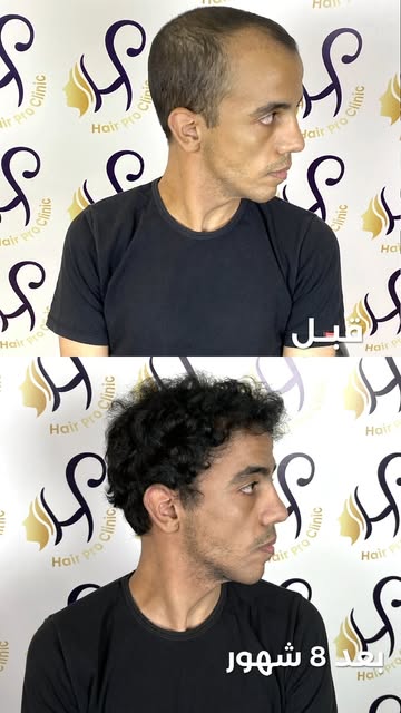 بعد 8 شهور من زراعة الشعر بـ 3000 جرافت ✨

من صلع في الدرجة الرابعة (أ) لنتيجة أوضح في الكثافة والتغ