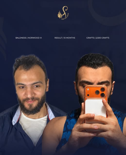 حالة صلع من الدرجة الثالثة، تم زراعة 2500 جرافت لاستعادة خط الشعر وتحسين كثافة المقدمة بشكل طبيعي.

