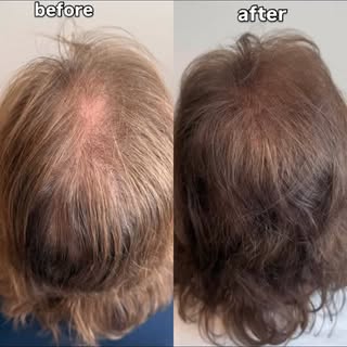 Results at 4 months. Hair loss or hair thinning is not a sentence. It takes time and effort, but hai