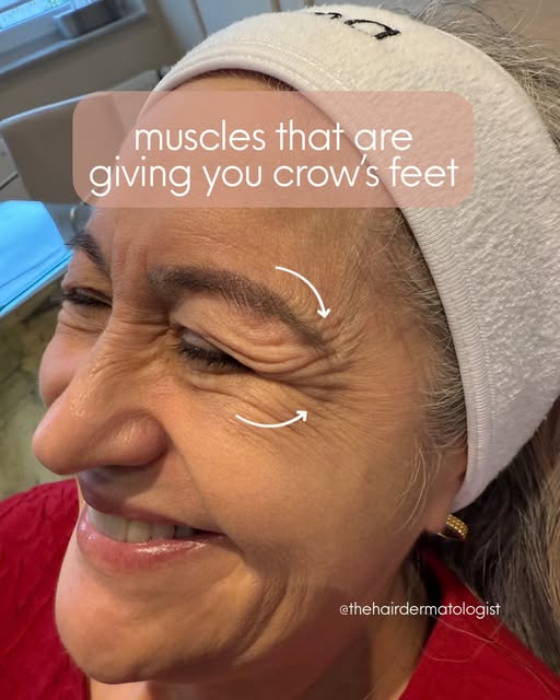 Crow’s feet are caused primarily by repeated contraction of the orbicularis oculi, the circular musc