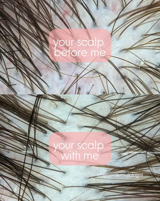 Inflammation of the scalp and hair follicles can sometimes be the underlying cause - and in certain 