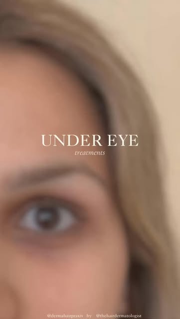 Under eye treatments are quite special. We have the option two work with a soft hyaluronic acid fill