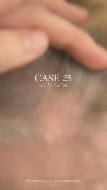 A round patch of hair loss doesn’t always mean alopecia areata. 

This patient had previously been d