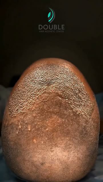 699$ فقط… لأن التغيير الحقيقي يستحق أكثر من مجرد وعد. 

في Double Hair، نقدم لك تجربة زراعة شعر متكا