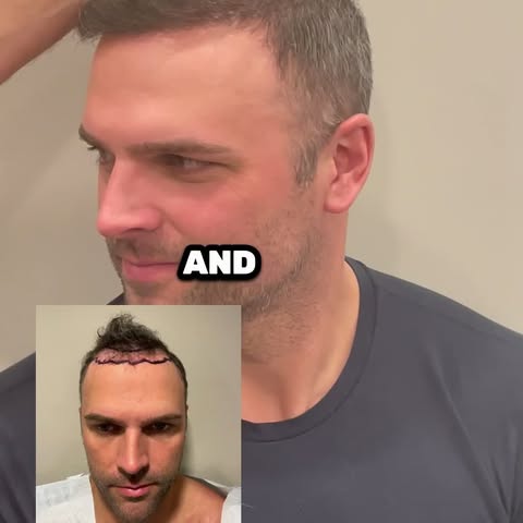 39-year-old patient ⭐ 10 Months Post-FUE Transplant

When this patient came to us, he was dealing wi