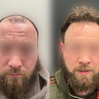 One year following an FUE Hair Transplant at our boutique Hair Transplant clinic Follicle HT.
Over 2