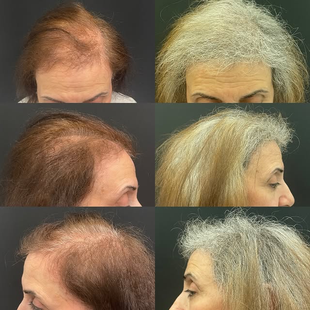 Very excited about this early result in a 69 year old woman who is 6 months out of an FUT hair trans