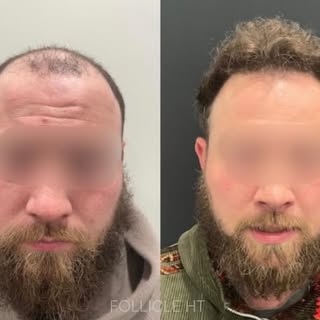 ✨FUE HAIR TRANSPLANT
✨Between 2000-2500 grafts
✨Patient is a 34 years male
📍Location: FollicleHT, S