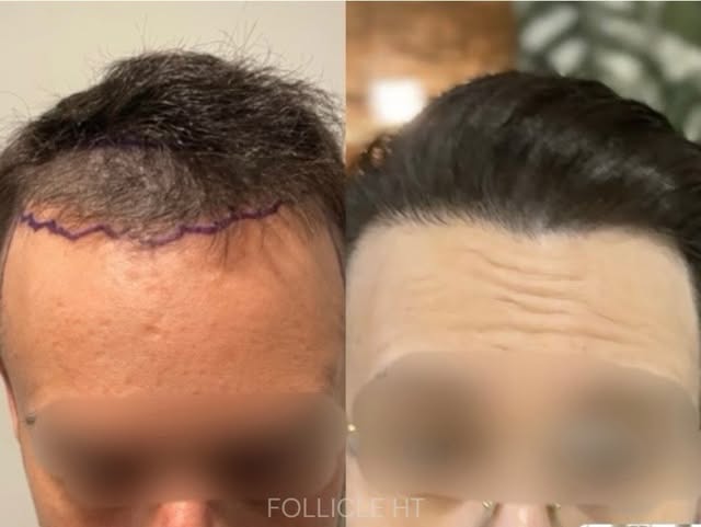 ✨FUE HAIR TRANSPLANT
✨2000-2500 grafts
✨Patient is a 33 year old male
📍Location: FollicleHT, SFP’s 