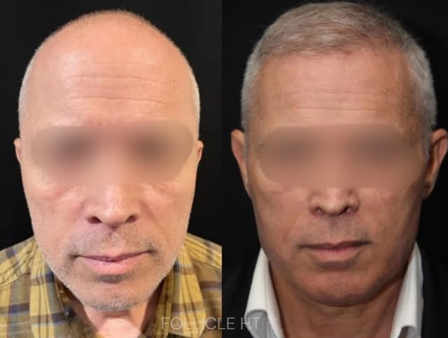✨FUE HAIR TRANSPLANT
✨2000-2500 grafts
✨58 year old male patient
📍Location: FollicleHT, SFP’s bouti