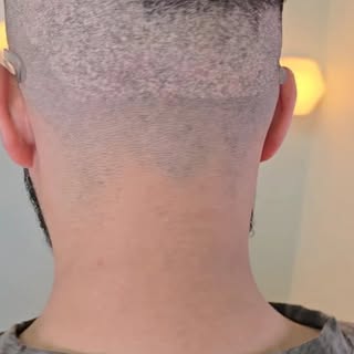 Worried about visible scars after a hair transplant? After just one year, they can be camouflaged so