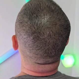 What does SMP look like after 1 year?

After 12 months, the pigment softens slightly, 
and that’s ex