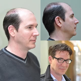 Chicago’s leading non-surgical hair replacement specialists. #NonSurgicalGrafting is, by far, the mo