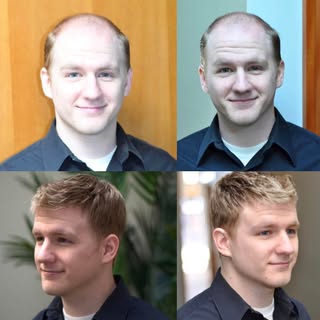 Having #HairLoss issues? #Alopecia, #TelogenEffluvium, #AnagenEffluvium,  etc..? Call today for a FR