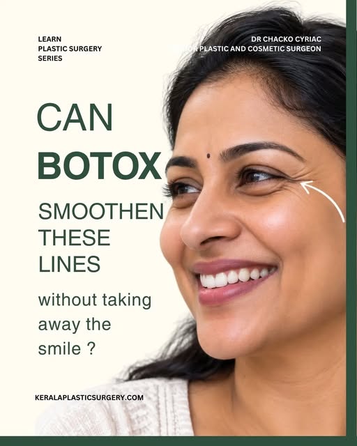 CAN BOTOX SMOOTH THESE LINES WITHOUT TAKING AWAY YOUR SMILE?

Those fine lines around the outer corn