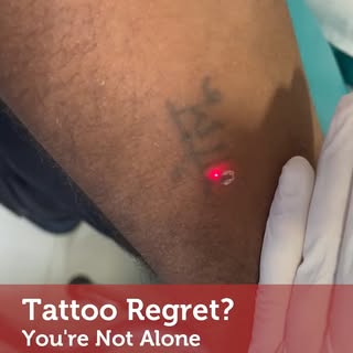 Tattoo regret? You’re not alone. ✨ 
Whether it’s an old decision, a style change, career concerns, o