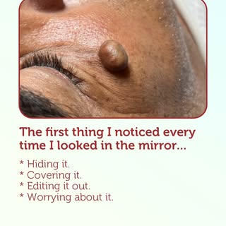 Every time you looked in the mirror, did you hide, cover, edit, or worry about that spot? 💆‍♀️✨ 
Ch