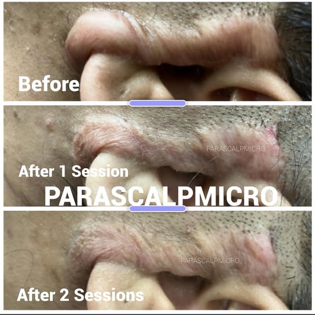 This is our newest Christmas Miracle! This woman had terrible Keloid from face lift surgery. She did