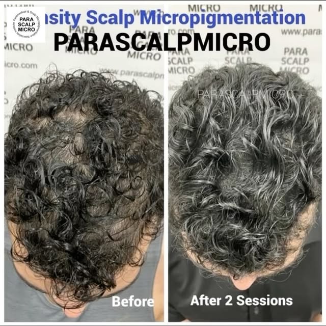 He did a lot of research to find us. Not every Scalp Micropigmentation Artist use Nano Technology or
