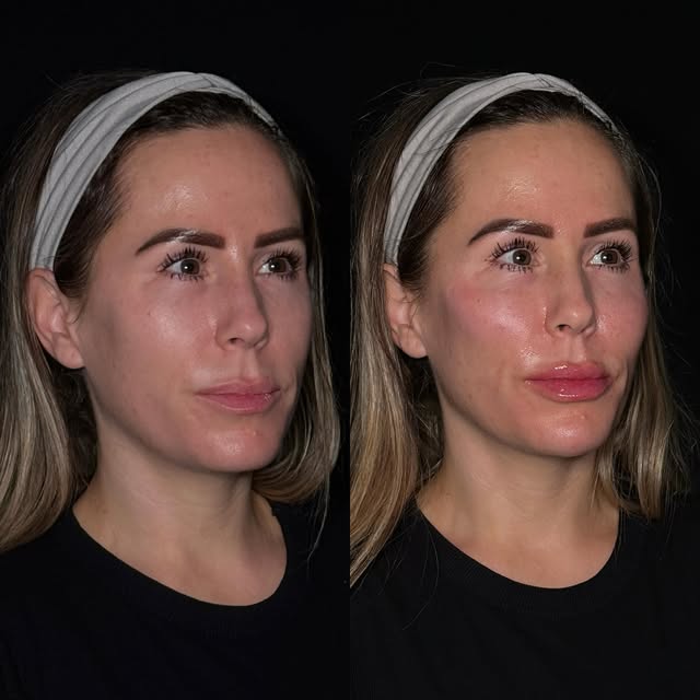Sometimes you don’t need MORE filler… you need the right filler, in the right places. 🤌🏼✨

One mon