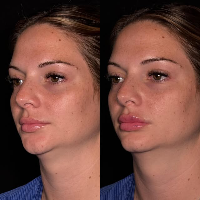 Subtle, soft, and SO pretty 💋✨

Sometimes you don’t need a full syringe to make a beautiful differe