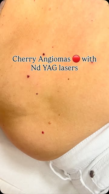 ✨ Cherry Angioma 🔴 Removal with Nd:YAG Laser ✨

Those small red spots on the skin can often be trea