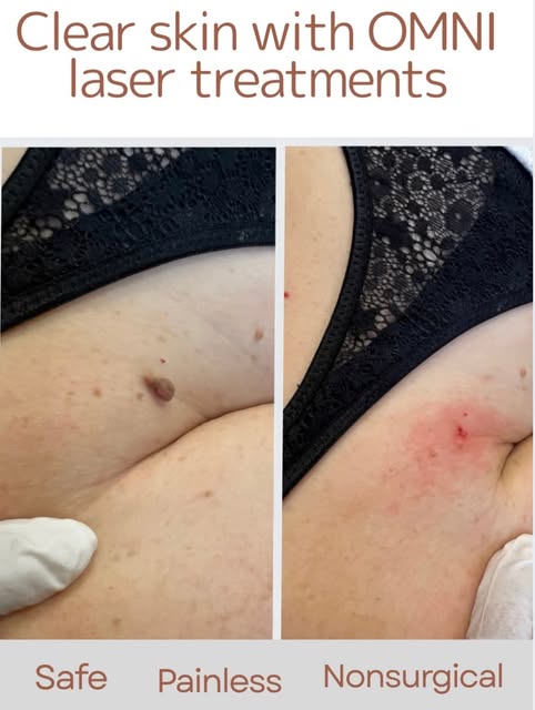 ✨ Smooth, Clearer Skin Starts Here! ✨

Say goodbye to unwanted skin tags with Fotona Erb YAG laser t