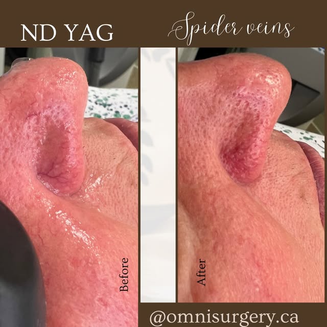 ✨ Say goodbye to spider veins! ✨

Spider veins can be treated with the Fotona Nd:YAG laser, a non-in