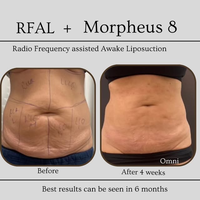 ✨ABDOMINAL TRANSFORMATION ✨

What happens when we combine RFAL-assisted liposuction + Morpheus8 RF m