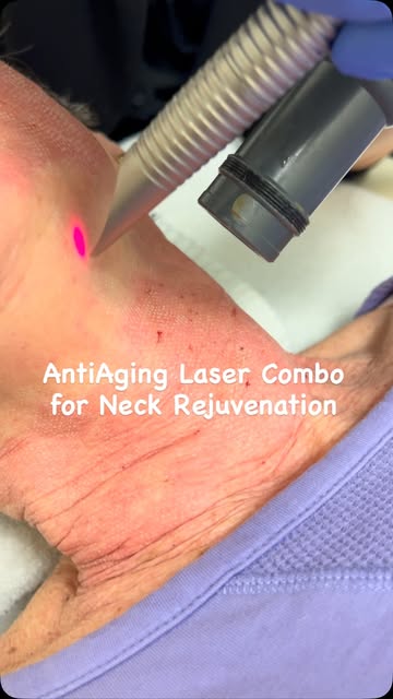 ✨ Neck Rejuvenation with Fotona Laser ✨

The neck deserves the same level of care as the face. 💫

O